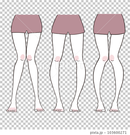 O型腿x型腿，骨盆變形 103600271