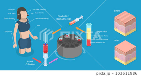 3D Isometric Flat Vector Conceptual Illustration of PRP Procedure 3D Isometric Flat Vector Conceptual Illustration of PRP Procedure 103611986