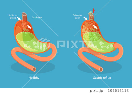 3D Isometric Flat Vector Conceptual Illustration of Stomach Reflux 103612118