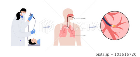 Bronchoscopy procedure concept Bronchoscopy procedure concept 103616720
