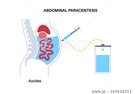 Abdominal paracentesis poster Abdominal paracentesis poster 103616721