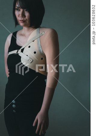 upper limb disability upper limb disability 103628632