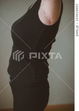 upper limb disability 103628665