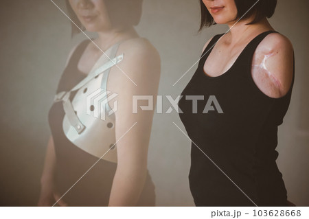 upper limb disability 103628668