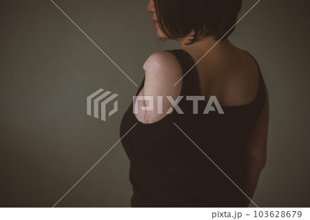 upper limb disability 103628679