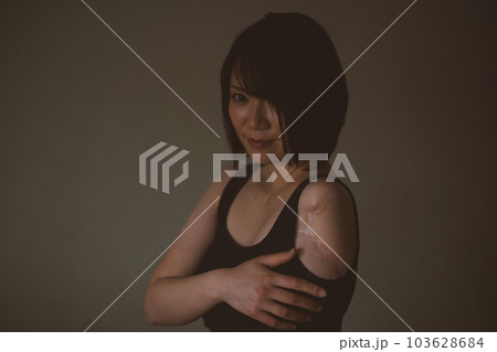 upper limb disability upper limb disability 103628684