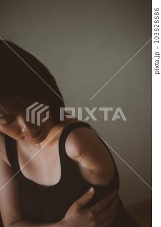 upper limb disability upper limb disability 103628686