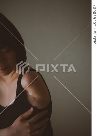 upper limb disability 103628687