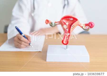 Doctor with Uterus and Ovaries anatomy model. Ovarian and Cervical cancer, Cervix disorder, Endometriosis, Hysterectomy, Uterine fibroids, Reproductive system, Pregnancy and health concept Doctor with Uterus and Ovaries anatomy model. Ovarian and Cervical cancer, Cervix disorder, Endometriosis, Hysterectomy, Uterine fibroids, Reproductive system, Pregnancy and health concept 103639677