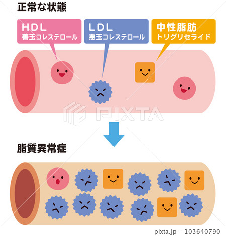 正常な状態の血管と、脂質異常症の血管　コレステロール 103640790