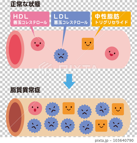 正常な状態の血管と、脂質異常症の血管　コレステロール 103640790