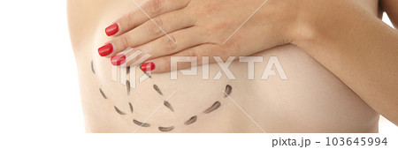 Woman breasts are marked for cosmetic surgery closeup Woman breasts are marked for cosmetic surgery closeup 103645994