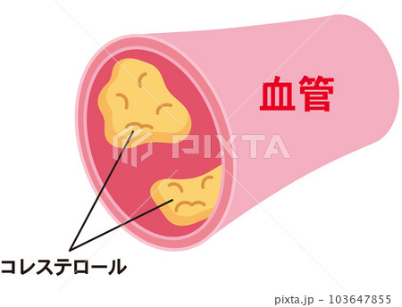 LDLとHDLの仕組み　脂質異常症　血管　コレステロール 103647855
