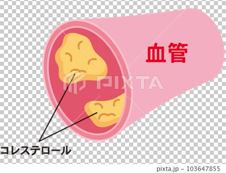 LDLとHDLの仕組み　脂質異常症　血管　コレステロール 103647855