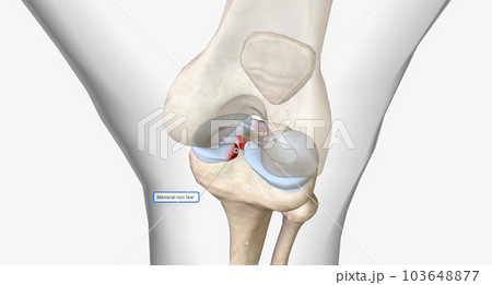 Meniscal root tears are less common than meniscal body tears and frequently go undetected. 103648877
