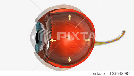 Human eye - glaucoma (eye disease) Human eye - glaucoma (eye disease) 103648906