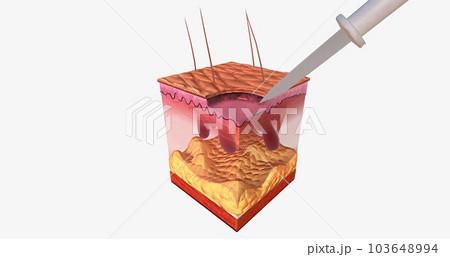The Curettage and Electrodesiccation Close Up 103648994