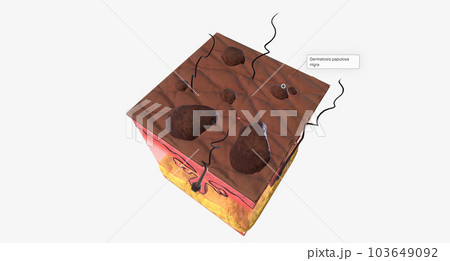 The DPN in Skin Tissue The DPN in Skin Tissue 103649092