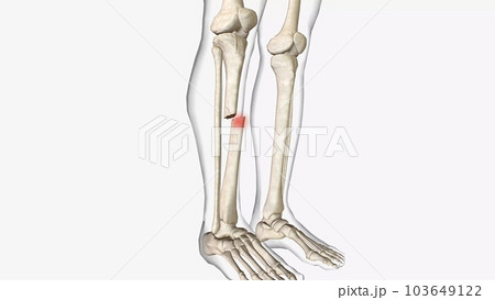 A fracture, often referred to as a broken bone, is an acute injury that causes a partial or complete break through bone. 103649122