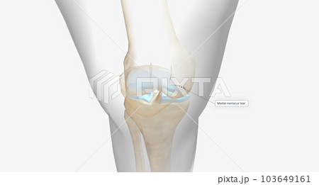 A meniscus tear is one of the most common knee injuries. 103649161