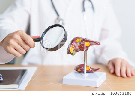 Doctor with human Liver model and Magnifying glass. Liver cancer and Tumor, Jaundice, Viral Hepatitis A, B, C, D, E, Cirrhosis, Failure, Enlarged, Hepatic Encephalopathy and Ascites Fluid in Belly Doctor with human Liver model and Magnifying glass. Liver cancer and Tumor, Jaundice, Viral Hepatitis A, B, C, D, E, Cirrhosis, Failure, Enlarged, Hepatic Encephalopathy and Ascites Fluid in Belly 103653180