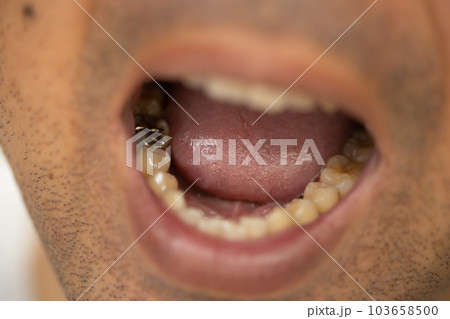 口を開けて歯を見せる男性　銀歯 103658500