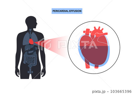 Pericardial effusion heart Pericardial effusion heart 103665396