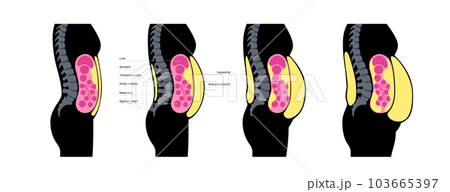 Visceral fat diagram 103665397