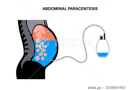 Abdominal paracentesis poster Abdominal paracentesis poster 103665401