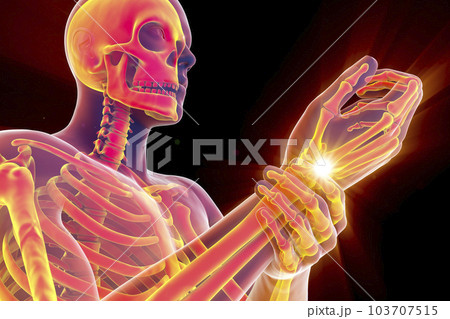 A man experiencing wrist pain, 3D illustration 103707515
