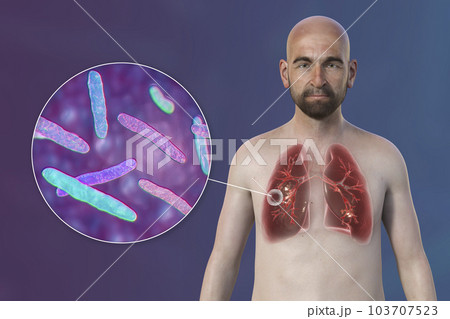 A 3D illustration of a man with transparent skin, showcasing the lungs affected by cavernous tuberculosis and close-up view of Mycobacterium tuberculosis bacteria 103707523