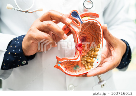 Stomach disease, doctor holding anatomy model for study diagnosis and treatment in hospital. 103716012