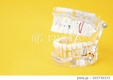 The transparent tooth model with dental implant on yellow background. The transparent tooth model with dental implant on yellow background. 103730315