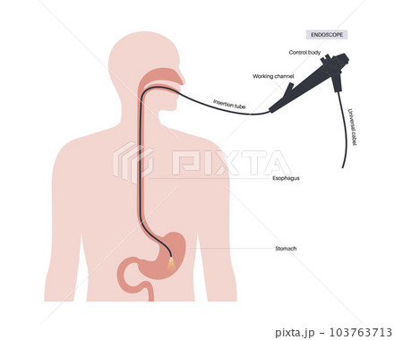 Gastroscopy endoscopy procedure 103763713