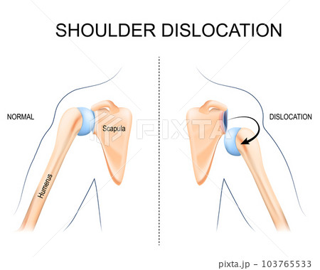 Shoulder dislocation. humerus bone trauma, 103765533