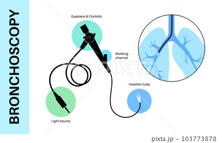 Bronchoscopy procedure concept Bronchoscopy procedure concept 103773878