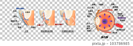 青光眼圖，信息圖表 103786985