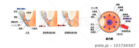 緑内障解説図，インフォグラフィック 103786987