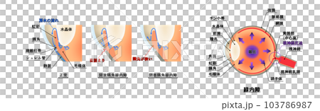 青光眼圖,信息圖表 青光眼圖,信息圖表 103786987