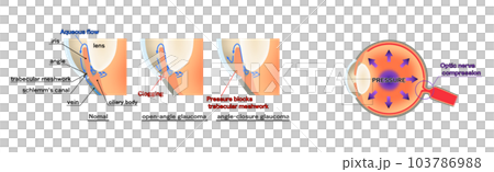 Glaucoma diagram, infographic, English 103786988