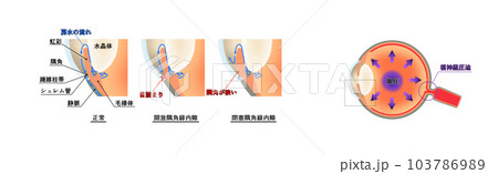 緑内障解説図，インフォグラフィック 103786989