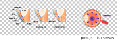緑内障解説図，インフォグラフィック 103786989