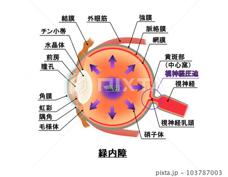 緑内障解説図，インフォグラフィック 103787003