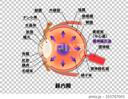 緑内障解説図，インフォグラフィック 103787003