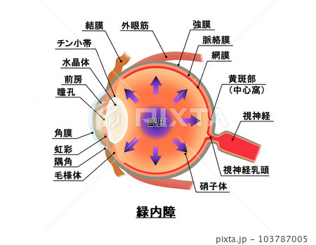 緑内障解説図，インフォグラフィック 103787005