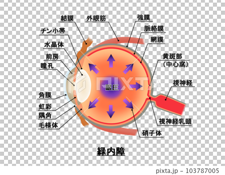 緑内障解説図，インフォグラフィック 103787005