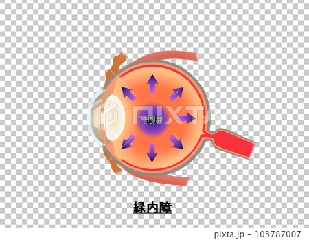 青光眼圖,信息圖表 青光眼圖,信息圖表 103787007