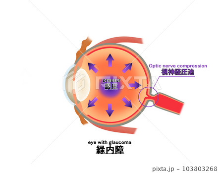 緑内障解説図，インフォグラフィック，日本語，英訳 103803268