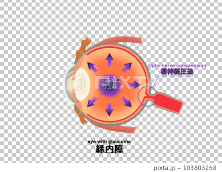 緑内障解説図，インフォグラフィック，日本語，英訳 103803268