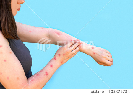 Monkeypox new disease dangerous over the world. Patient with Monkey Pox. Painful rash, red spots blisters on the hand. Close up rash, human hands with Health problem. Banner, copy space 103829783